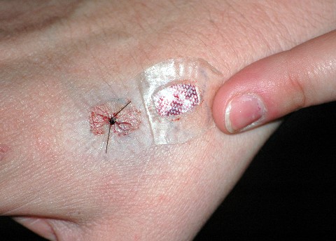 sutures1.jpg